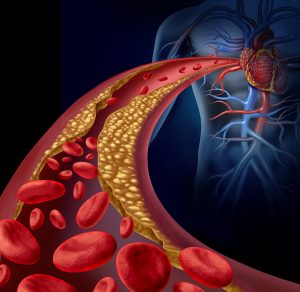 arteries with cholesterol